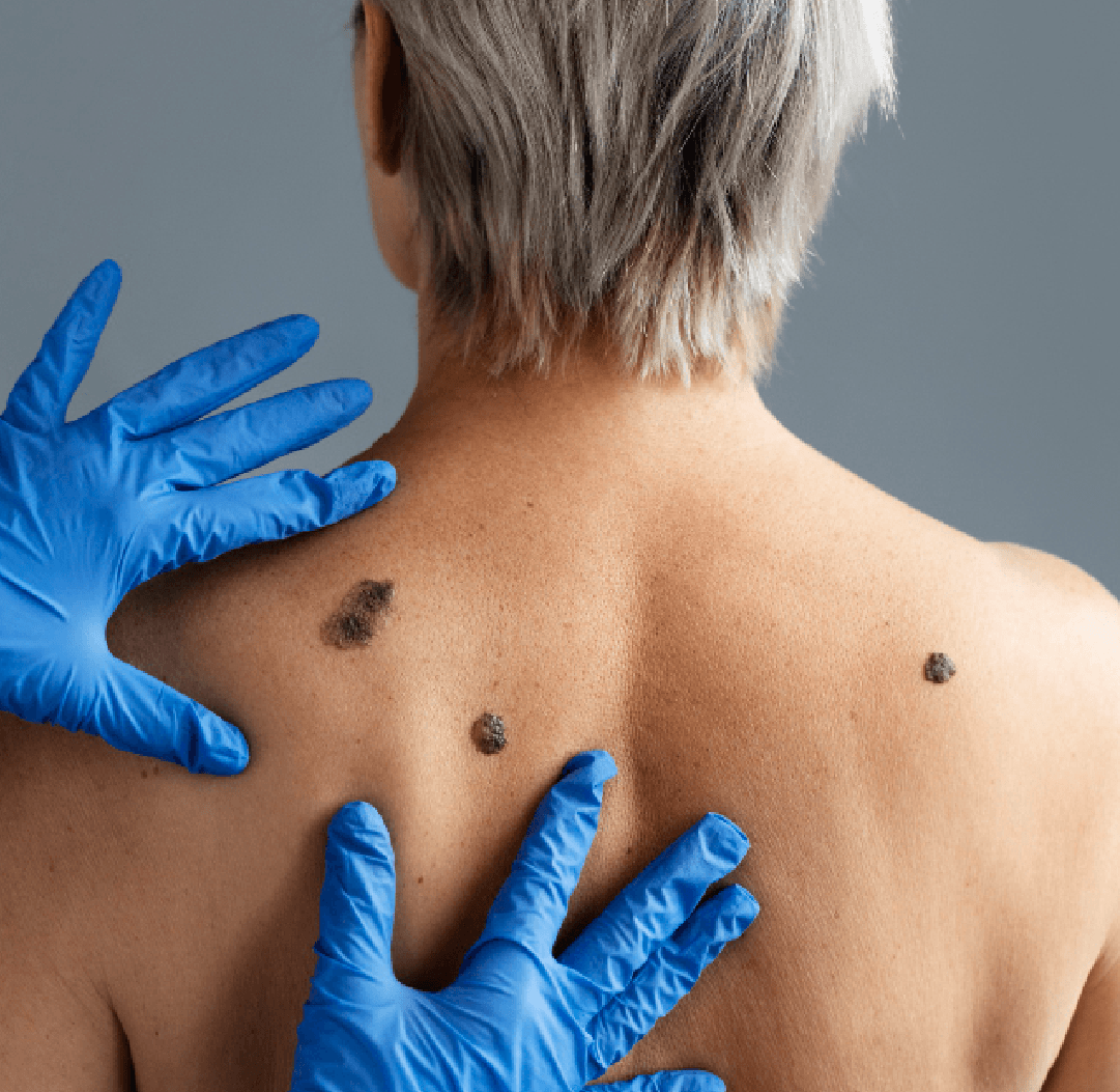 Imagen representativa de cirugía de cáncer de piel y reconstrucción